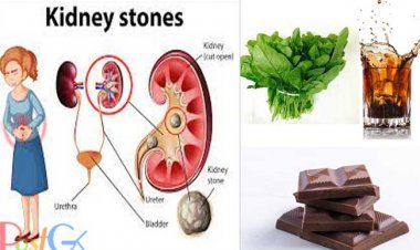 किडनी स्टोन से पीड़ित हैं तो न खाएं ये चीजें, नहीं तो हो सकती है गंभीर समस्या